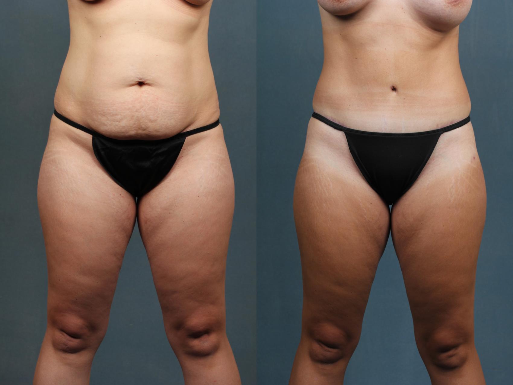Before & After Tummy Tuck Case 588 View #2 View in Louisville & Lexington, KY