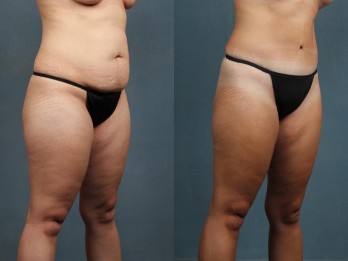 Before & After Tummy Tuck Case 588 View #3 View in Louisville & Lexington, KY