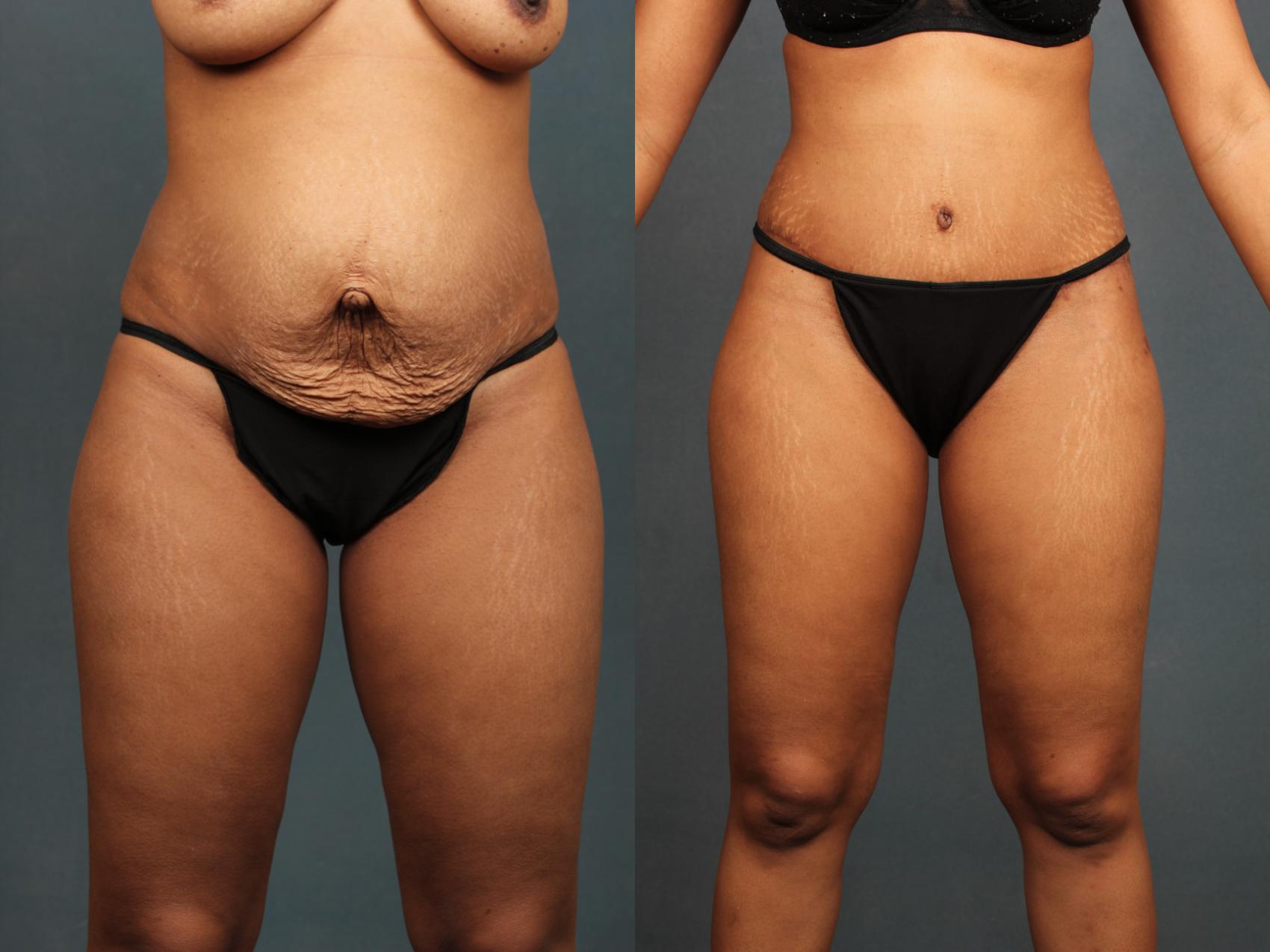 Before & After Tummy Tuck Case 592 View #1 View in Louisville & Lexington, KY