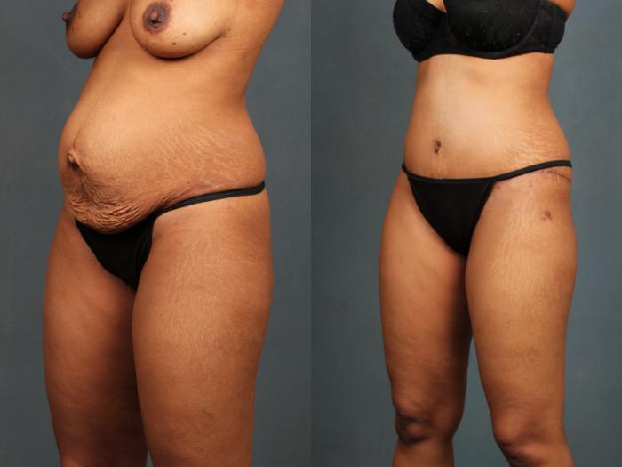 Before & After Tummy Tuck Case 592 View #2 View in Louisville & Lexington, KY