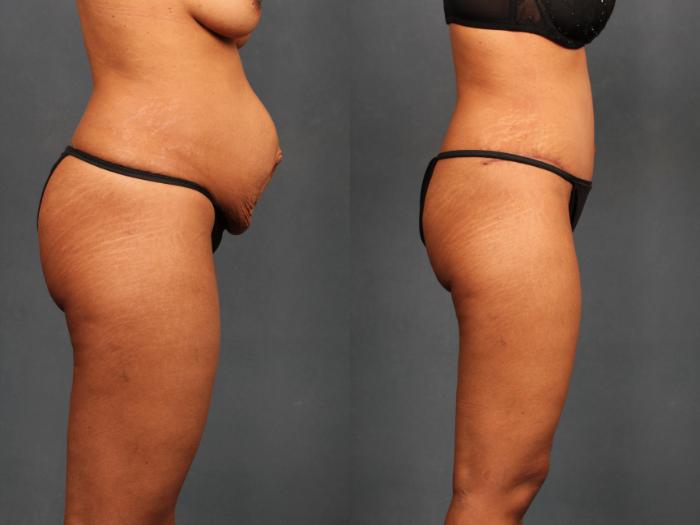 Before & After Tummy Tuck Case 592 View #3 View in Louisville & Lexington, KY