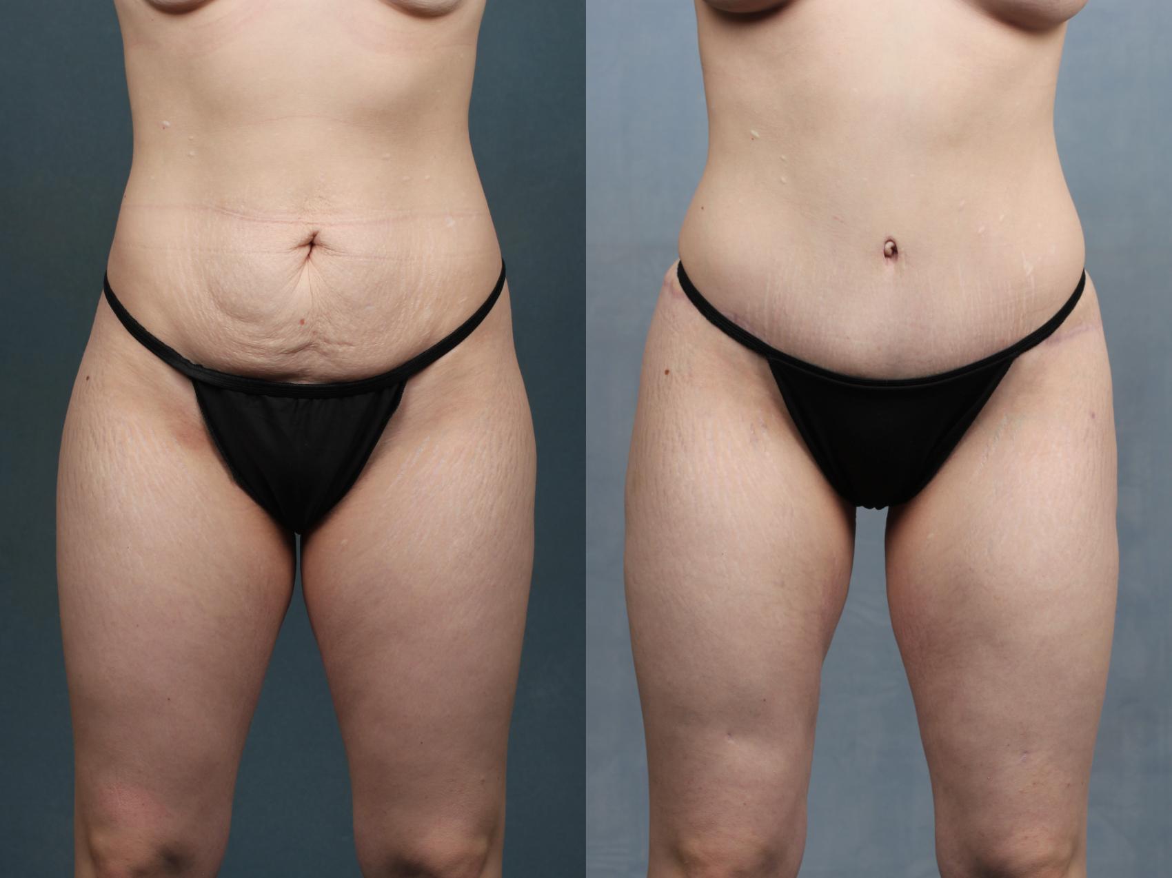 Before & After Tummy Tuck Case 598 View #1 View in Louisville & Lexington, KY
