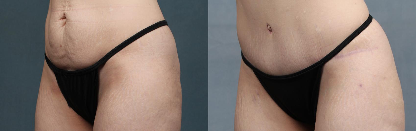 Before & After Tummy Tuck Case 598 View #2 View in Louisville & Lexington, KY