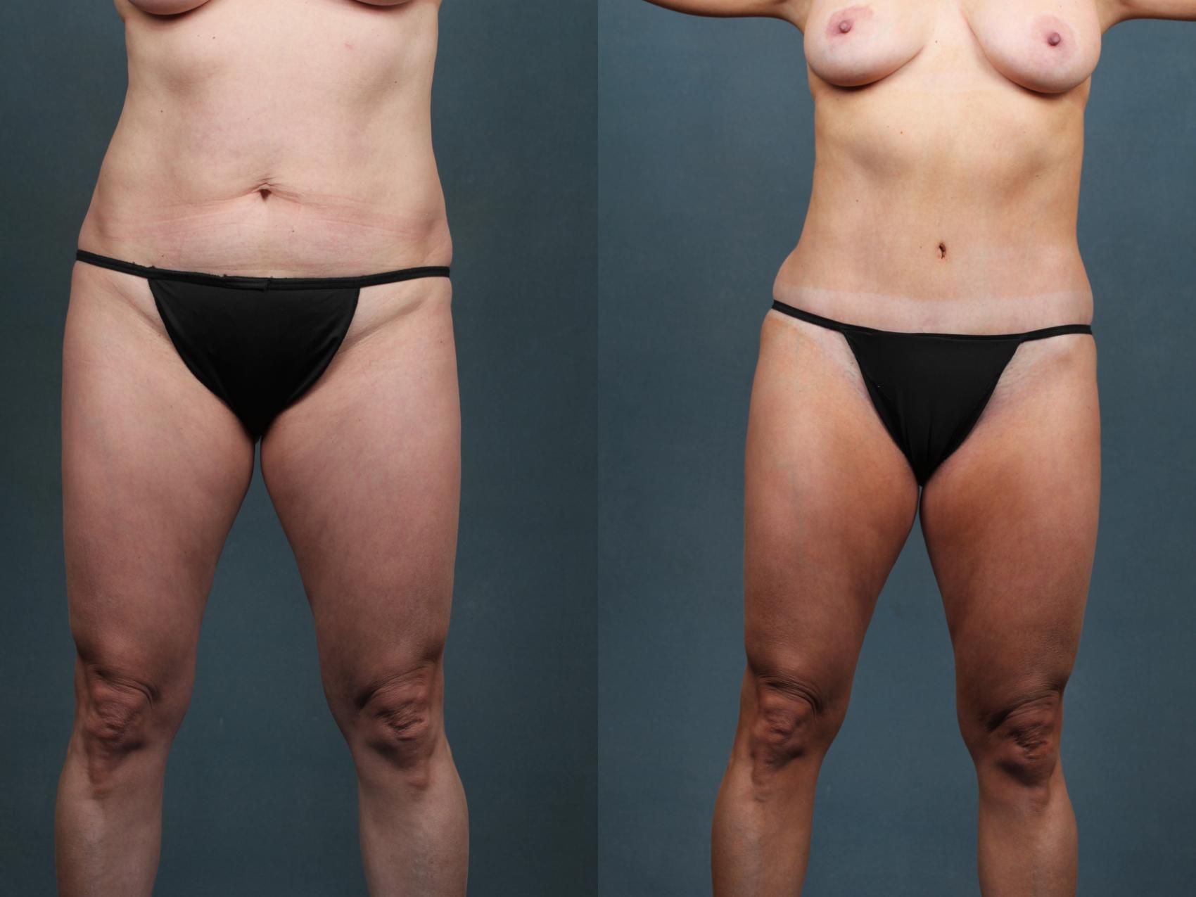Before & After Tummy Tuck Case 602 View #1 View in Louisville & Lexington, KY