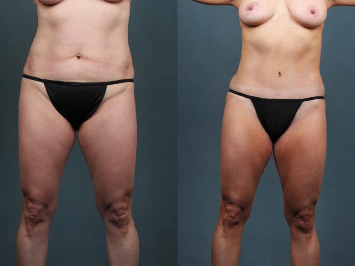 Before & After Tummy Tuck Case 602 View #1 View in Louisville, KY
