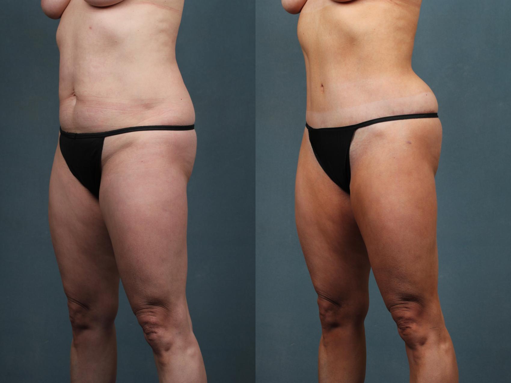 Before & After Tummy Tuck Case 602 View #2 View in Louisville & Lexington, KY