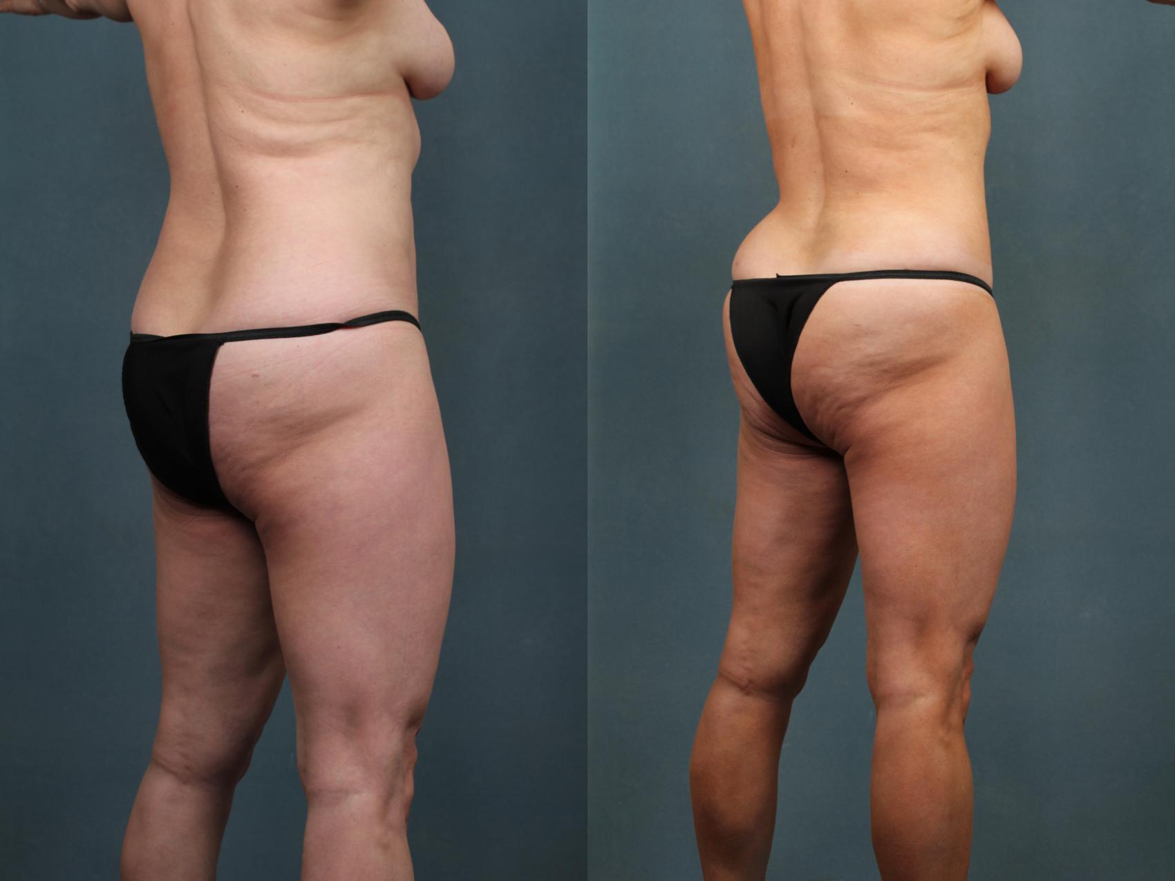 Before & After Tummy Tuck Case 602 View #3 View in Louisville & Lexington, KY