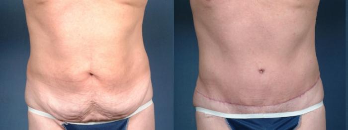Before & After Liposuction Case 721 Front View in Louisville & Lexington, KY