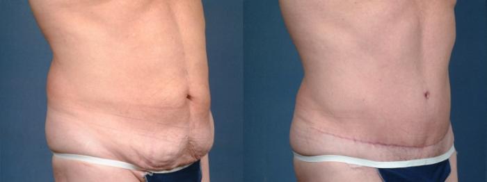 Before & After Tummy Tuck Case 721 Left Oblique View in Louisville & Lexington, KY