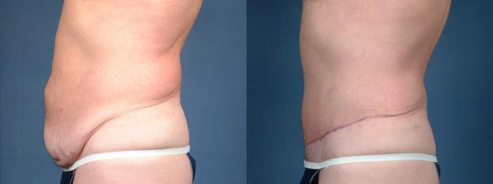 Before & After Liposuction for Men Case 721 Left Side View in Louisville & Lexington, KY