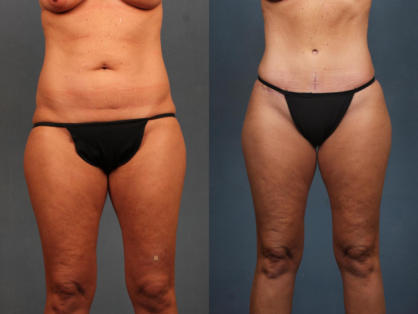 Tummy tuck with liposuction to hips and back