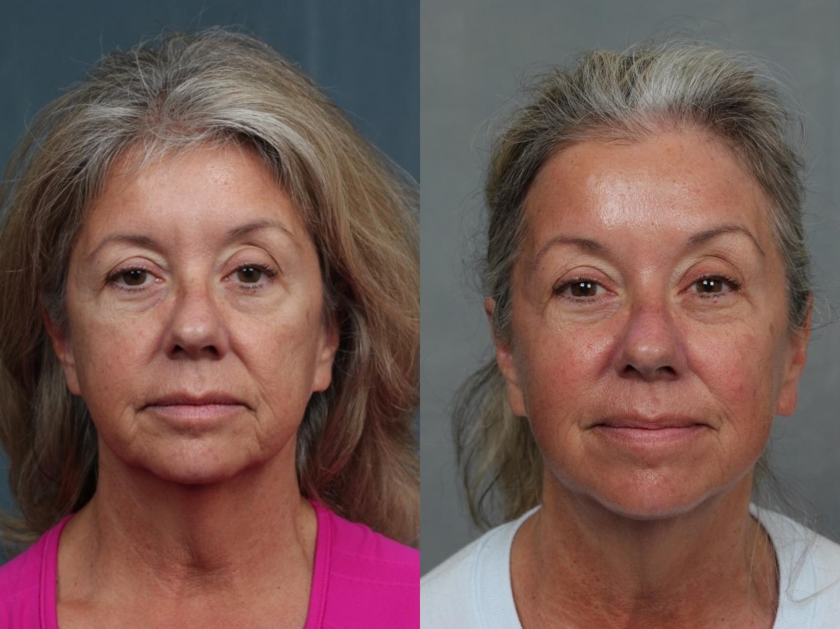 Before & After Ultherapy Case 689 Front View in Louisville, KY