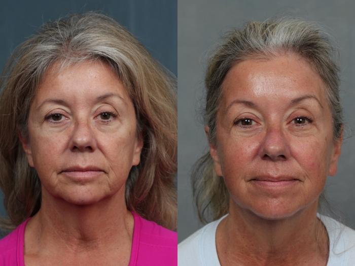 Before & After Ultherapy Case 689 Front View in Louisville & Lexington, KY