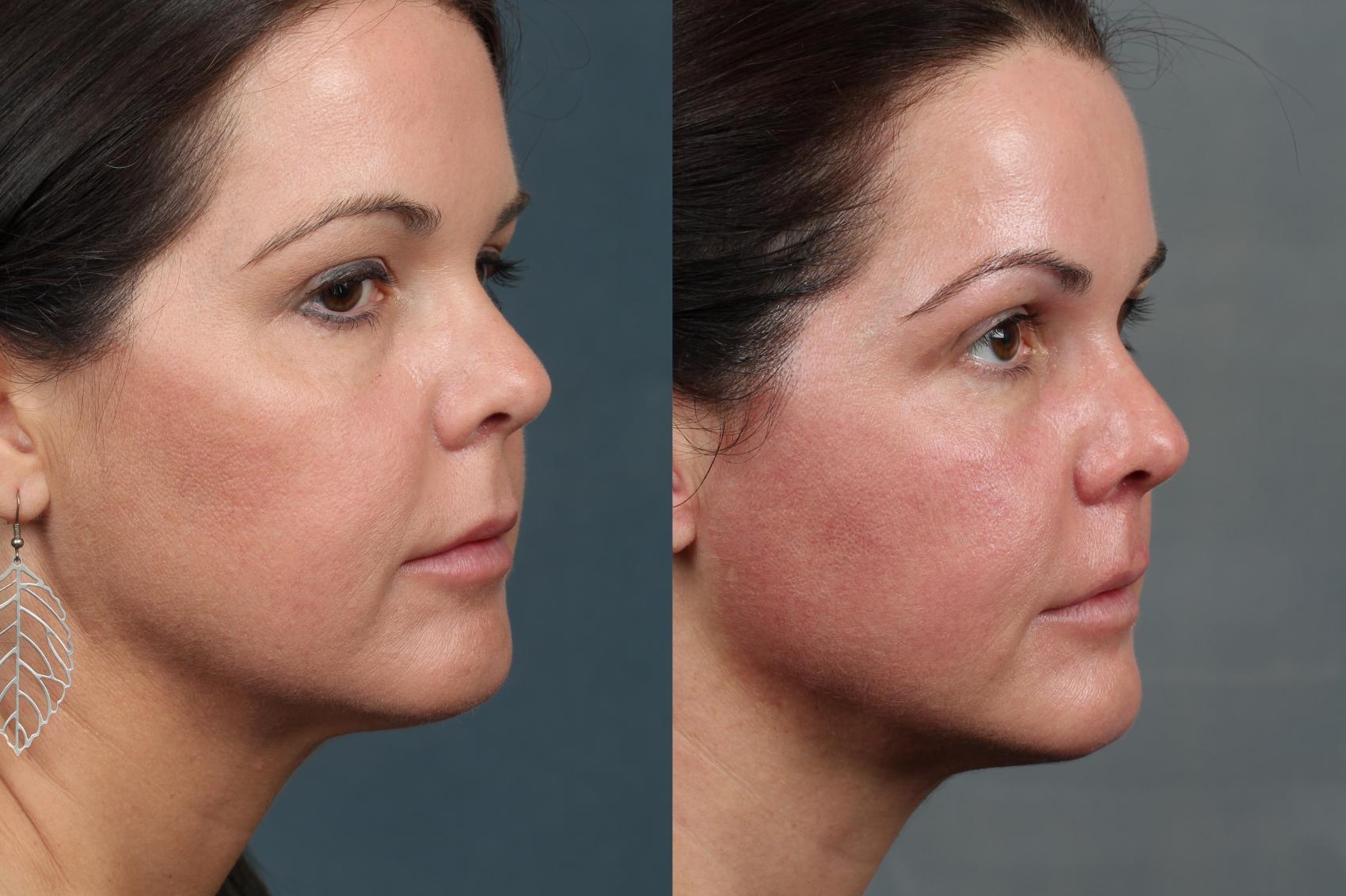 Before & After Ultherapy Case 704 Right Oblique View in Louisville & Lexington, KY